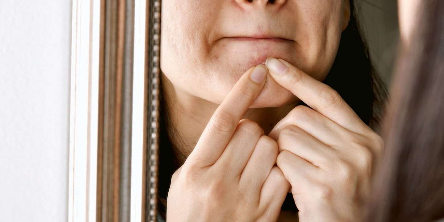 Will Acne Disappear by Itself? Here Is the Scientific Answer!