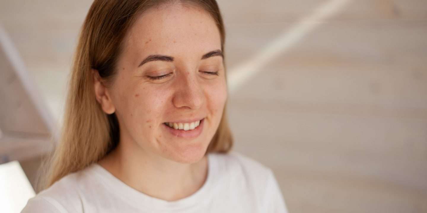 How to treat stubborn Cystic Acne: Tips from a Dermatologist