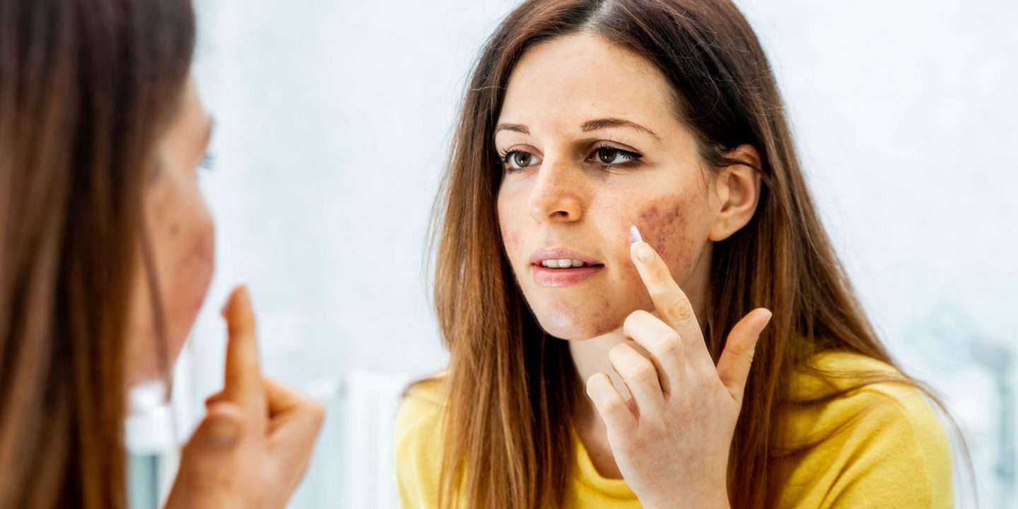 What causes acne and how do I treat it?