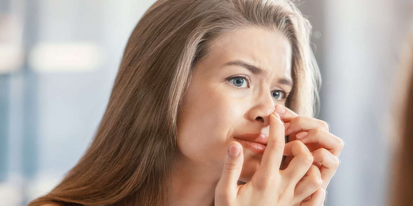 Acne Vulgaris Treatment and Management