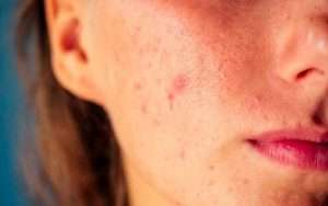 acne papules