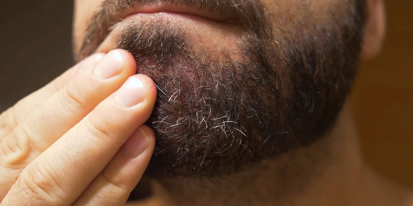 Seborrheic Dermatitis: What is it, diagnosis and treatment